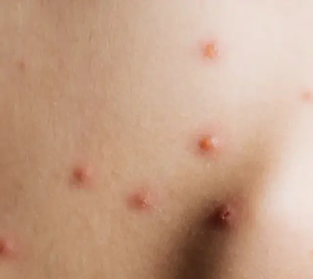 Piel con erupciones rojas y elevadas, parecidas a picaduras, que podrían ser confundidas con pulgas en humanos.